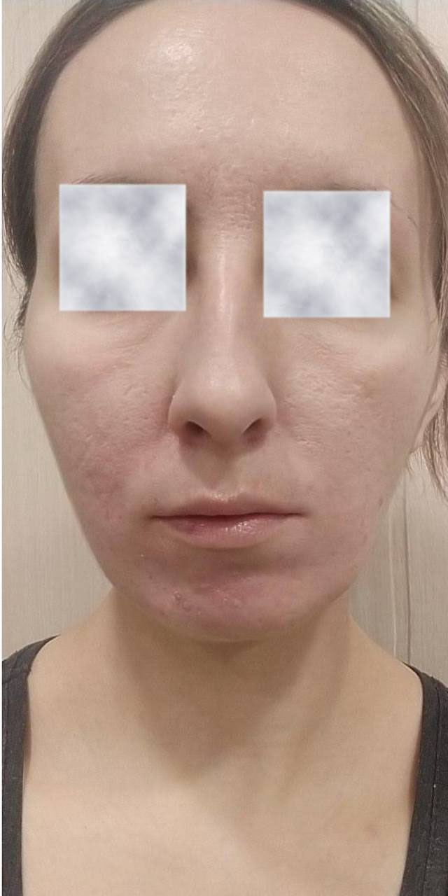 After image