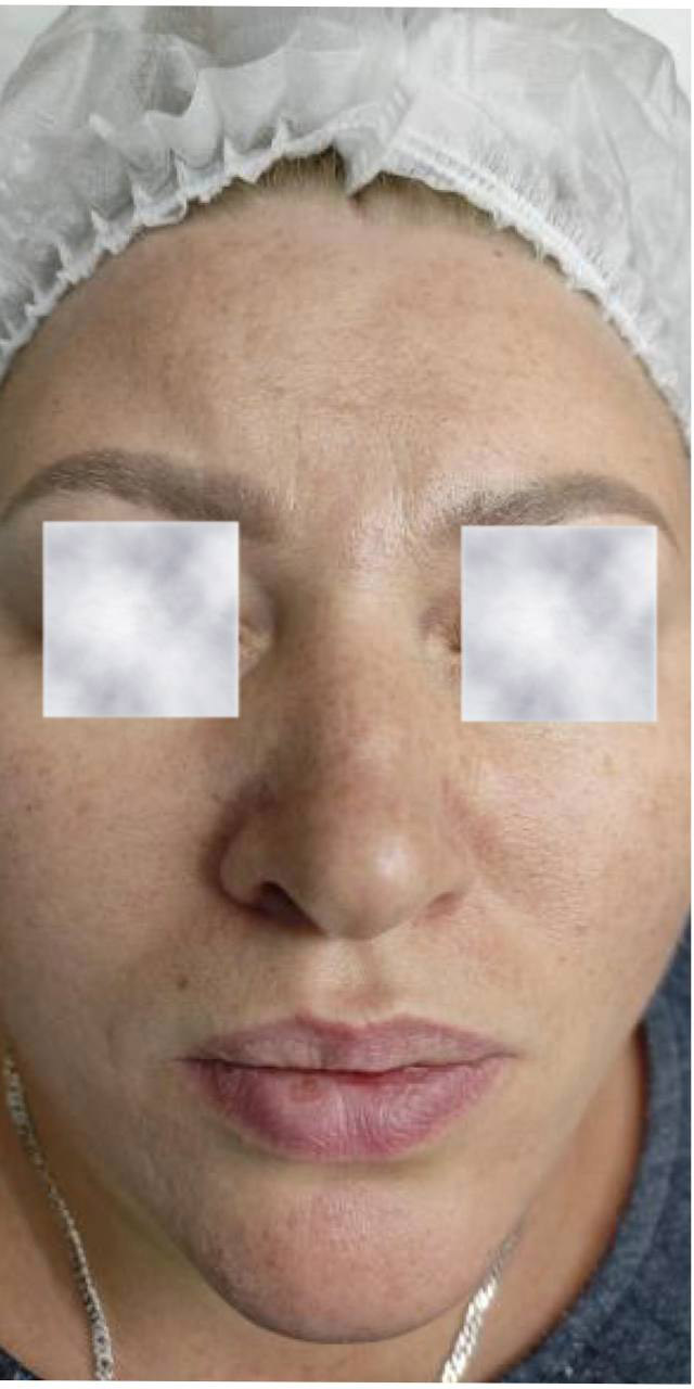 Before image