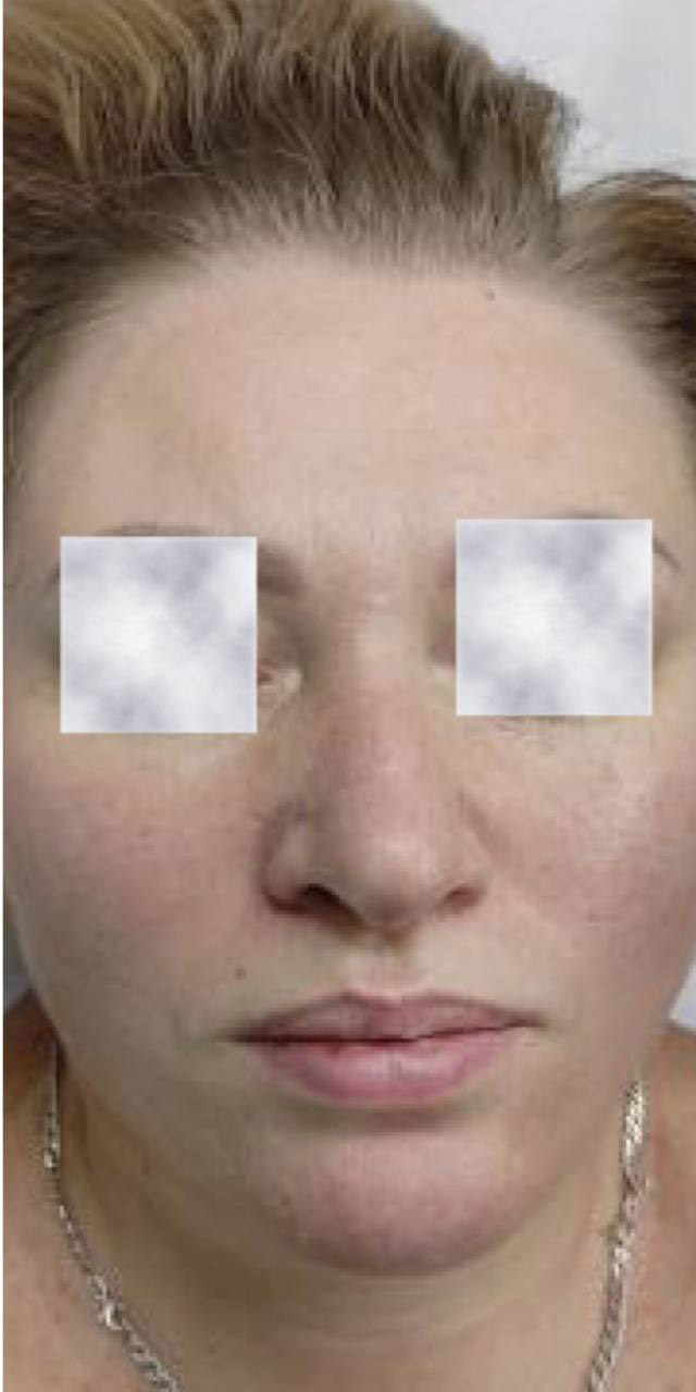 After image