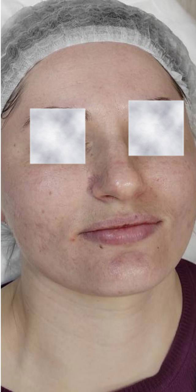 After image
